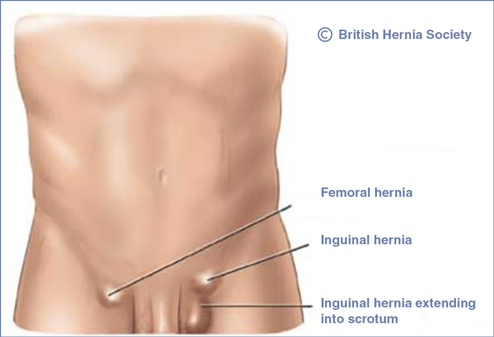 Symptoms of femoral hernia